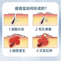 克莱氏 净颜清痘乳30ml 涂于痘痘或者脓肿处、化解红/肿痘痘、淡化痘印/不留痕迹、改善痘痘/痘印/粉刺/暗疮、平滑细嫩